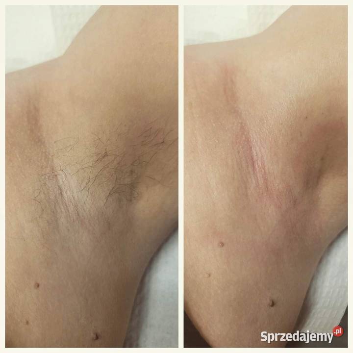 Depilacja cukrowa Twoja skóra zasługuje na Zdrowie i Uroda Chorzów