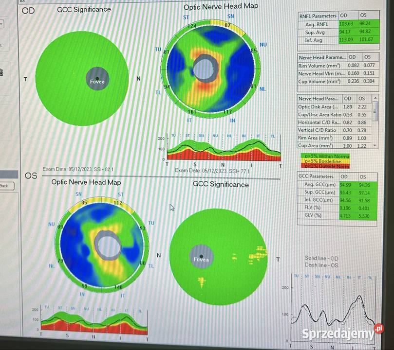 Oct Soct tomograf okulistyczny łódzkie Łódź