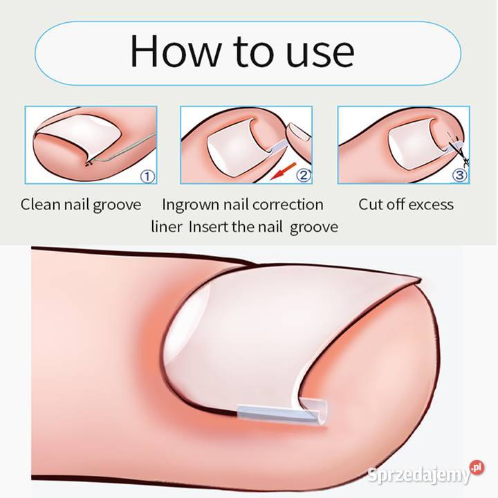 Podkładki silikonowe na wrastające paznokcie Płock
