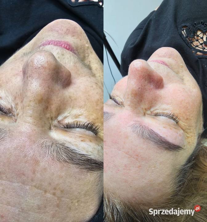 Oczyszczanie wodorowe Chorzów