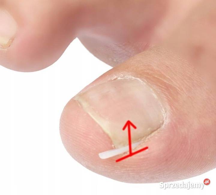 Podkładki silikonowe na wrastające paznokcie mazowieckie sprzedam