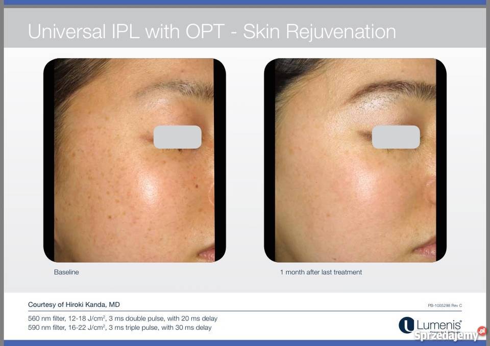 M22 Luenis Coherent Polska