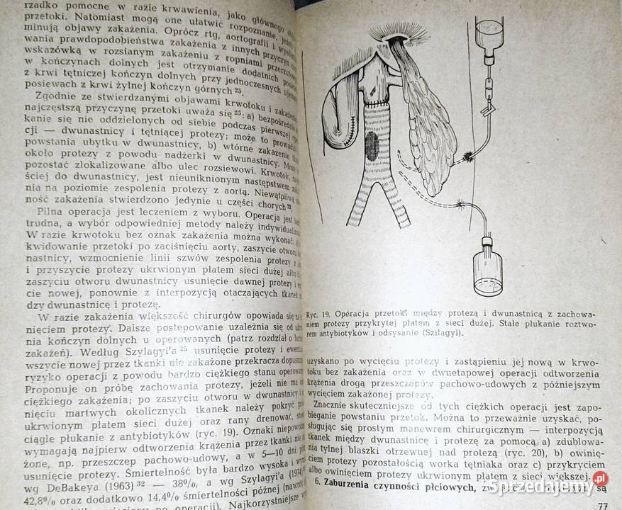 Powikłania operacjach naczyń krwionośnych H lubelskie Chełm