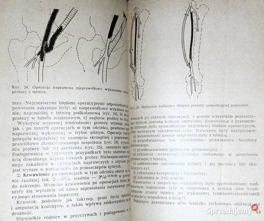 Powikłania operacjach naczyń krwionośnych H Chełm