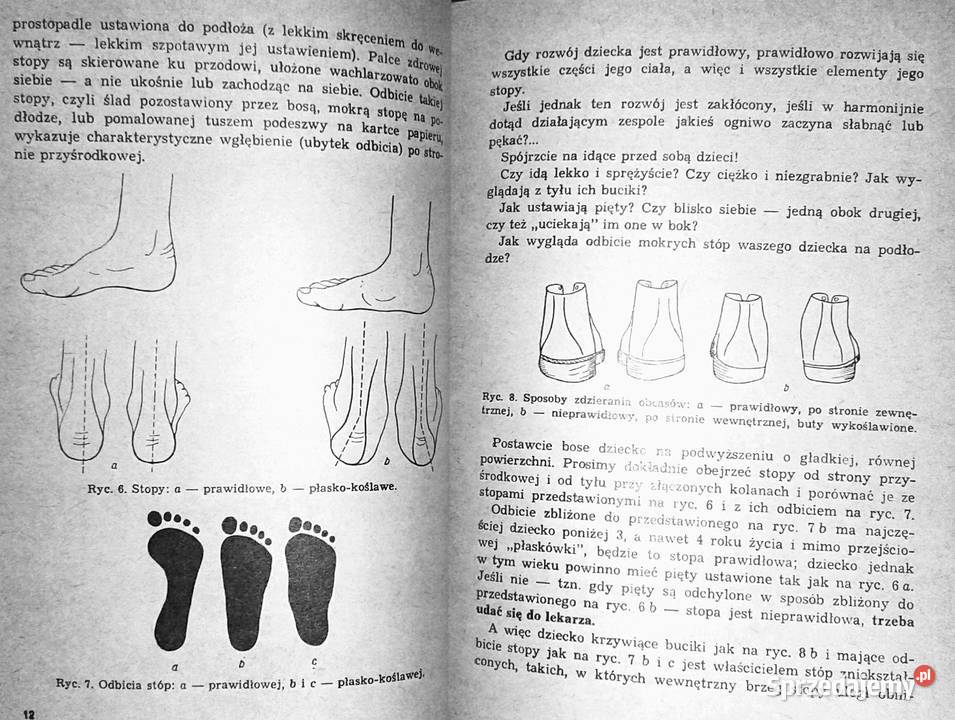 Stopy płaskie u dzieci gimnastyka lecznicza