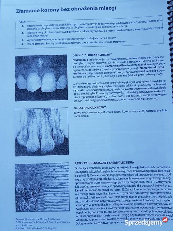 Pourazowe uszkodzenia zębów stomatologia sprzedam