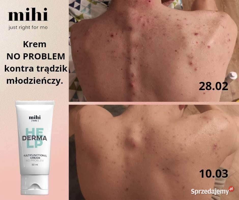 Krem NO PROBLEM Łuszczyca AZS Sucha skóra