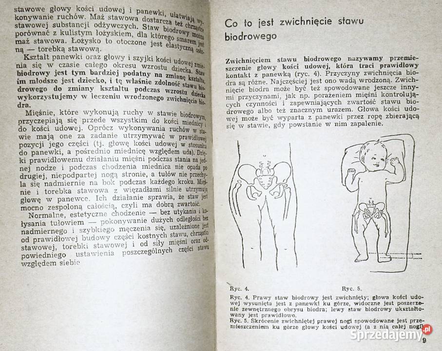 Wrodzone zwichnięcie biodra jest uleczalne Karol Chełm