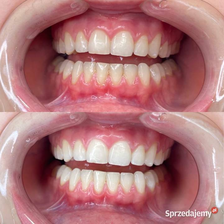 Wybielanie zębów model biznesowy plus sprzęt Zdrowie i Uroda Warszawa