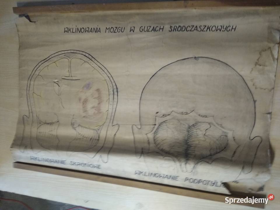 plakat o wklinowaniu mózgu w guzach Warszawa