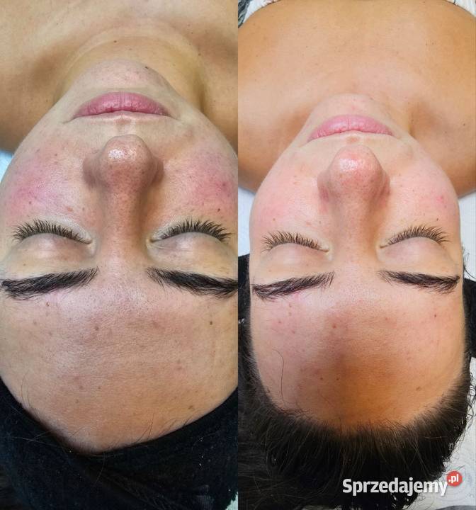 Oczyszczenie wodorowe Chorzów