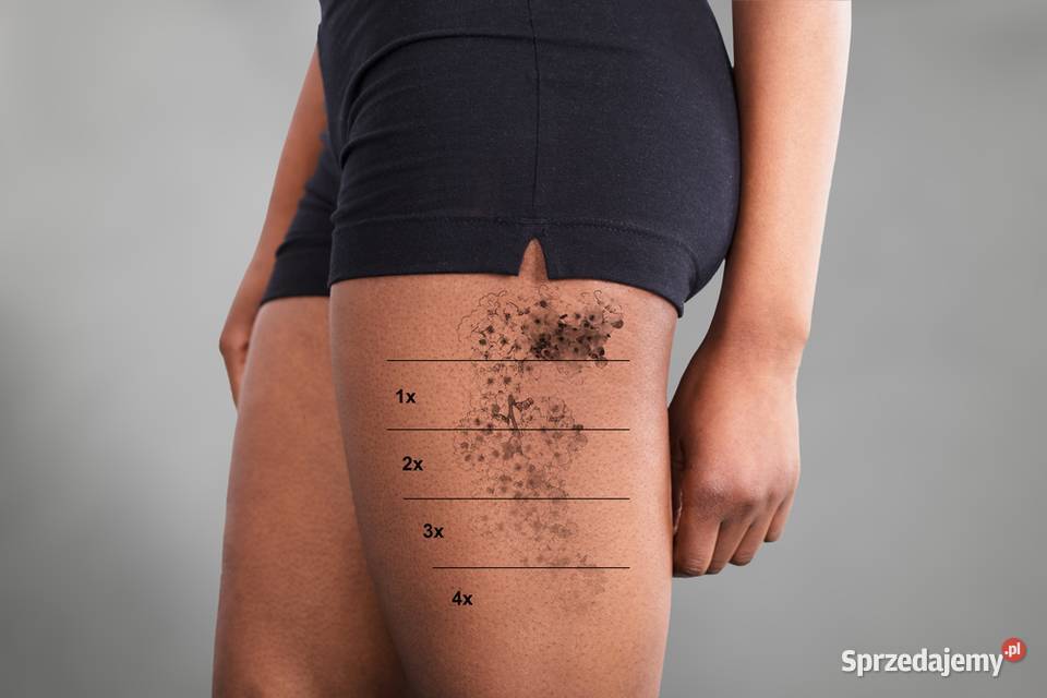 PicoCare laser picosekundowy do usuwania tatuazy