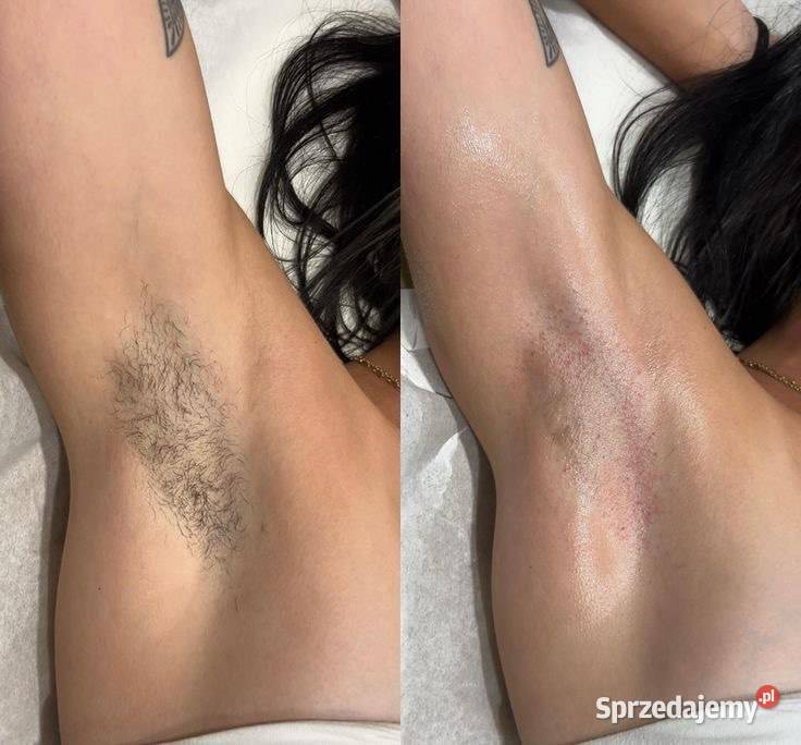 Depilacja cukrowa gładka skóra bez podrażnień śląskie Chorzów