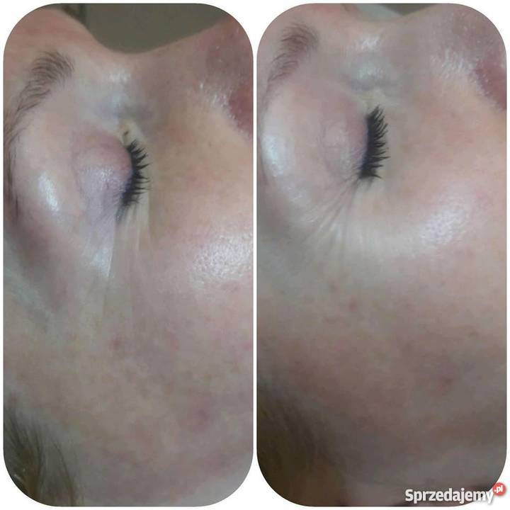 PROMOCJA HIFU lifting skóry 1599 Pozostałe lubuskie Gorzów Wielkopolski