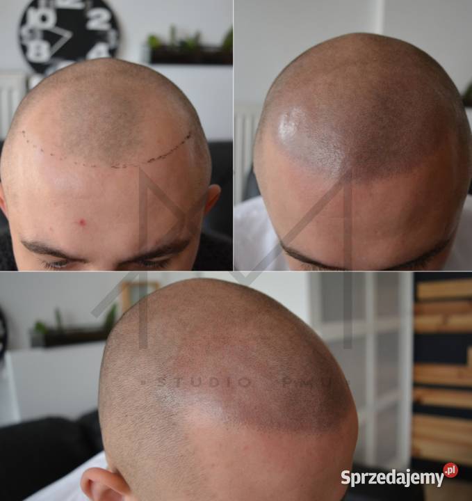Mikrowłókna Nanowłókna Nanogen HairFor2 DERMAX łódzkie Łódź