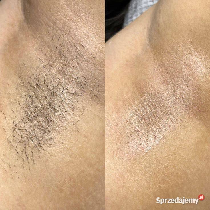 Depilacja cukrowa Pokochaj swoją skórę na nowo