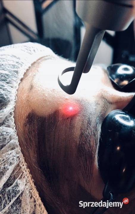 Laser do usuwania pigmentów ND YAG Q switch Gdańsk