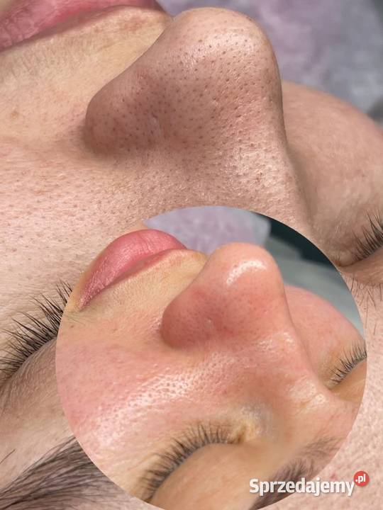 Delikatne a skuteczne oczyszczanie wodorowe Zdrowie i Uroda Chorzów sprzedam