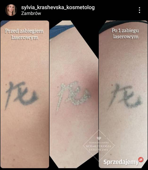 Sprzedam laser QSWITCH do usuwania tatuaży Zambrów