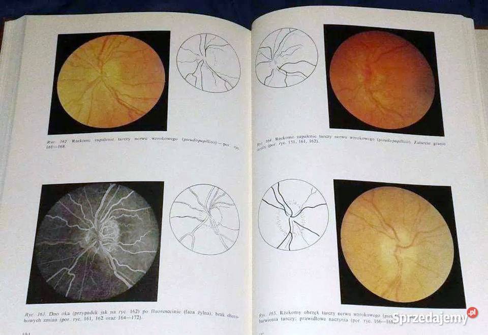 Dno oka w nadciśnieniu tętniczym Edward Bryk Chełm