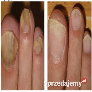 Skuteczny sposób na grzybicę paznokci sprawdzony Lubiatów