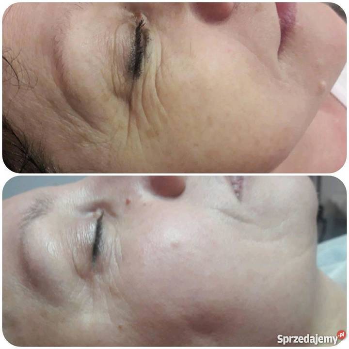 PROMOCJA HIFU lifting skóry 1599 Gorzów Wielkopolski