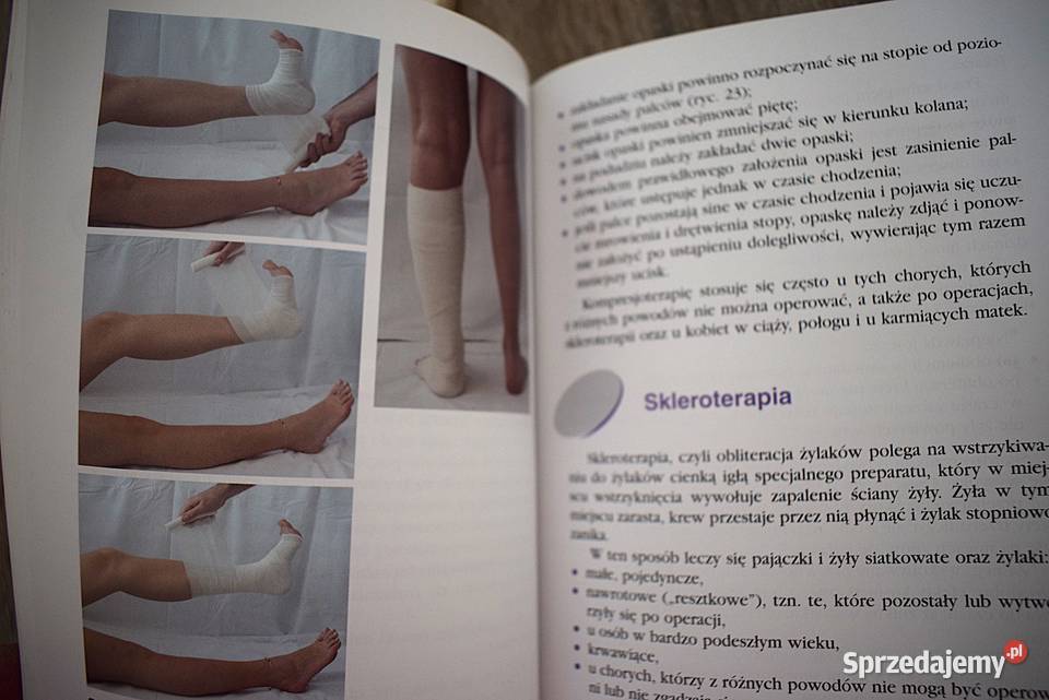 Żylaki leczenie profilaktyka przyczyny objawy Chełmno sprzedam