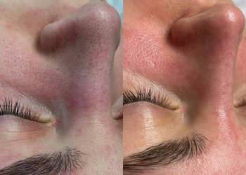 Oczyszczenie wodorowe Detoks skóry w nowoczesnym wydaniu