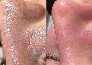 Oczyszczenie wodorowe Czysta skóra, czysta energia