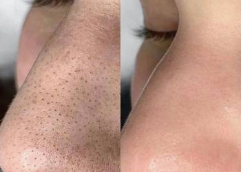 Oczyszczenie wodorowe czysta skóra to 99,8% twojego idealnego wyglądu