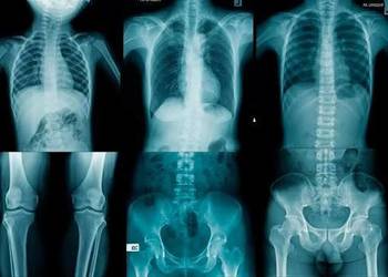 Klisze RTG, każda ilość.