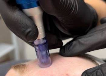 Oczyszczanie wodorowe – zdrowa promienna skóra Chorzów Batorego 10