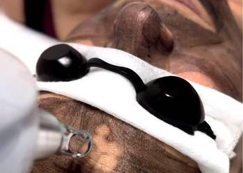 Peeling węglowy – laserowy sposób na młodszą skórę
