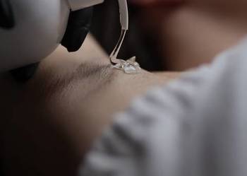 Laserowa depilacja Chorzów