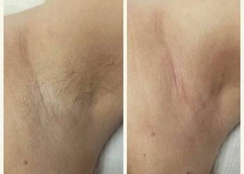 Depilacja cukrowa Twoja skóra zasługuje na cukrową pielęgnację