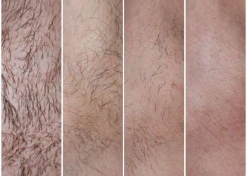 Depilacja cukrowa gładka skóra na 4 tygodni