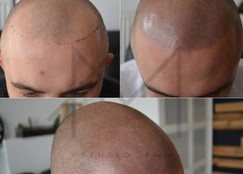 Mikrowłókna Nanowłókna Nanogen HairFor2 DERMAX