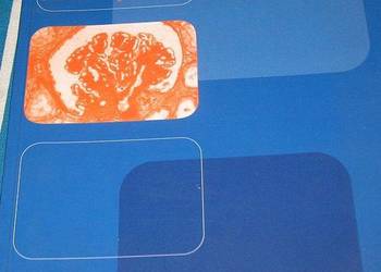 NEFROPATIA CUKRZYCOWA - GRZESZCZAK WŁADYSŁAW