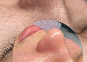 Delikatne, a skuteczne oczyszczanie wodorowe ✨